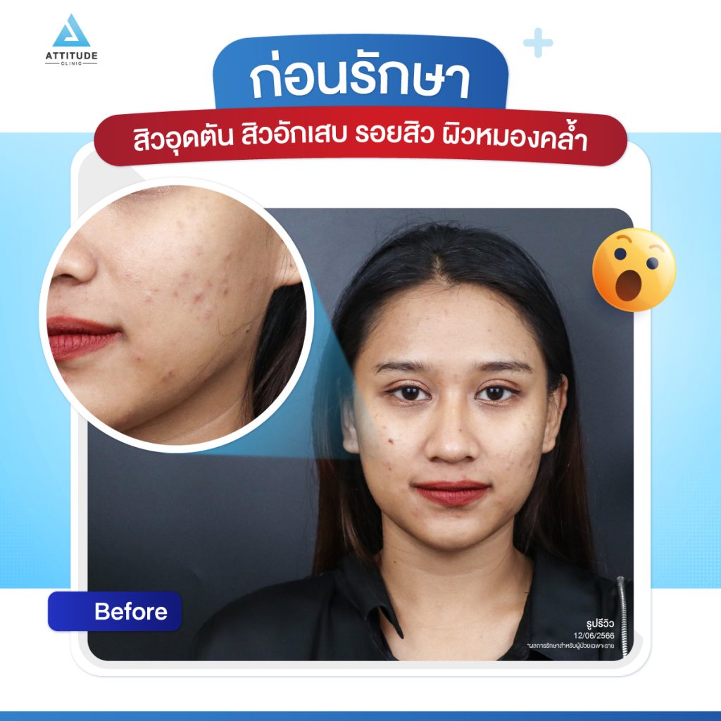 เสกหน้าใส แบบคูณ 2 ต้องรักษาสิว + เลเซอร์ รักษาครอบคลุม จบทุกปัญหาสิวและรอยสิว