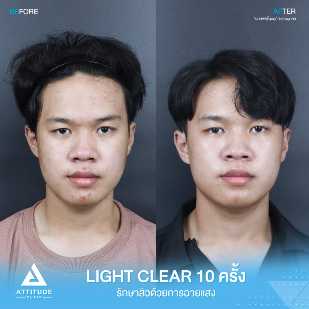 รีวิวรักษาสิวคุณบุ๊ค ด้วยการฉายแสง Light Clear 7 ขั้นตอน จำนวน 10 ครั้ง ที่มีปัญหาสิวอักเสบ สิวฮอร์โมน สิวอุดตัน รอยแดงจากสิว อยากให้ผิวหน้าเรียบเนียนขึ้น ผิวใส เพิ่มความมั่นใจ