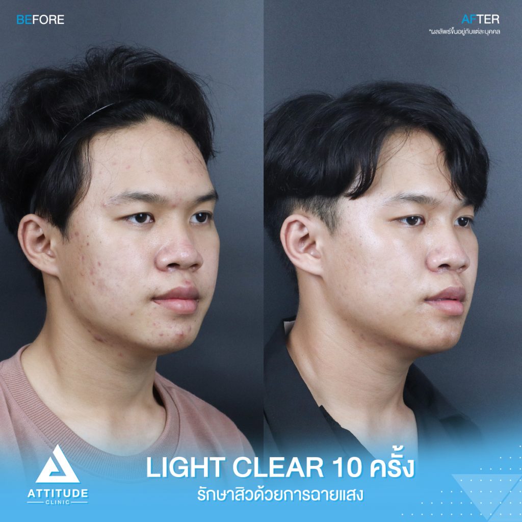 รีวิวรักษาสิวคุณบุ๊ค ด้วยการฉายแสง Light Clear 7 ขั้นตอน จำนวน 10 ครั้ง ที่มีปัญหาสิวอักเสบ สิวฮอร์โมน สิวอุดตัน รอยแดงจากสิว อยากให้ผิวหน้าเรียบเนียนขึ้น ผิวใส เพิ่มความมั่นใจ