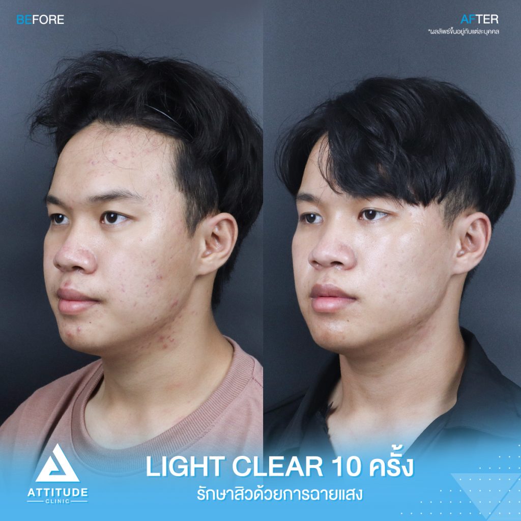 รีวิวรักษาสิวคุณบุ๊ค ด้วยการฉายแสง Light Clear 7 ขั้นตอน จำนวน 10 ครั้ง ที่มีปัญหาสิวอักเสบ สิวฮอร์โมน สิวอุดตัน รอยแดงจากสิว อยากให้ผิวหน้าเรียบเนียนขึ้น ผิวใส เพิ่มความมั่นใจ