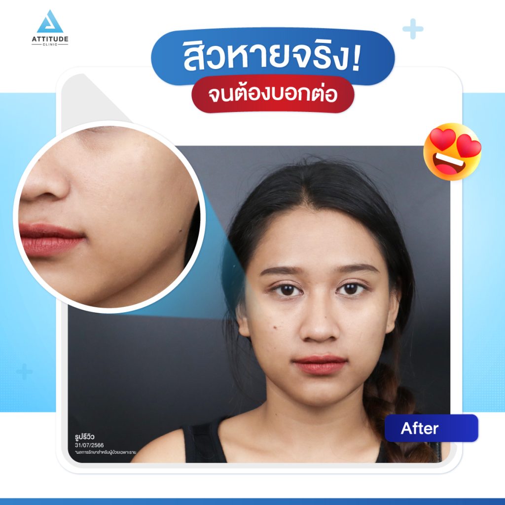 เสกหน้าใส แบบคูณ 2 ต้องรักษาสิว + เลเซอร์ รักษาครอบคลุม จบทุกปัญหาสิวและรอยสิว