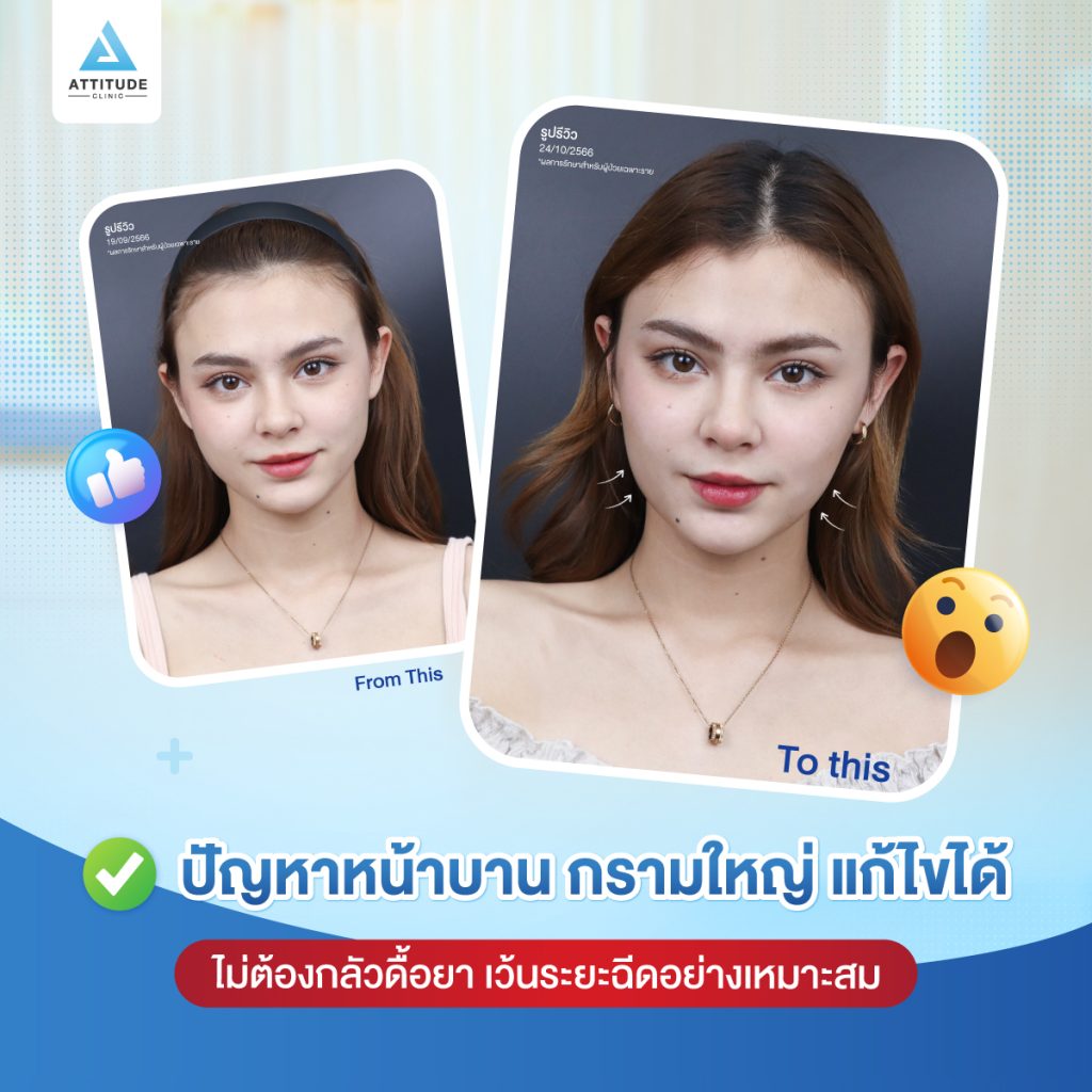 ปรับรูปหน้า ลดขนาดกล้ามเนื้อกราม จึ้งจนเพื่อนต้องทัก มาปรึกษาหมอก่อนได้ พร้อมดูแล ใส่ใจ ดูดยาให้ดู อยากให้เห็นผลชัดเจนที่ Attitude Clinic