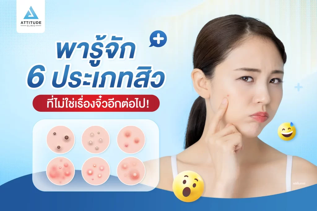 พารู้จัก 6 ประเภทสิว ที่ไม่ใช่เรื่องจิ๋วอีกต่อไป เคยสงสัยกันหรือไม่ ว่าสิวที่เป็นอยู่คือสิวอะไร ?