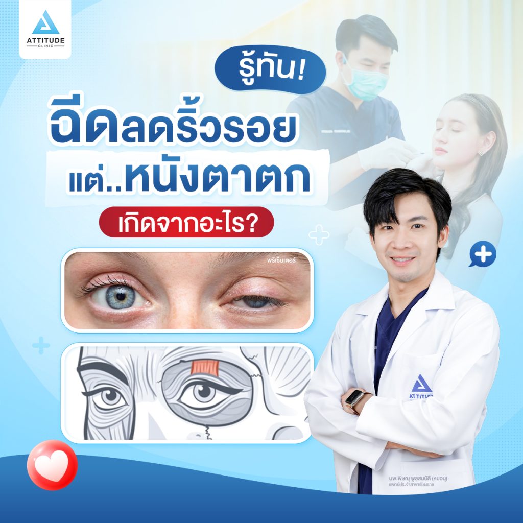 หลังฉีดโบท็อกซ์แล้วหนังตาตก ตาไม่เท่ากัน เกิดจากอะไร มาหาคำตอบไปพร้อมๆ กัน!!