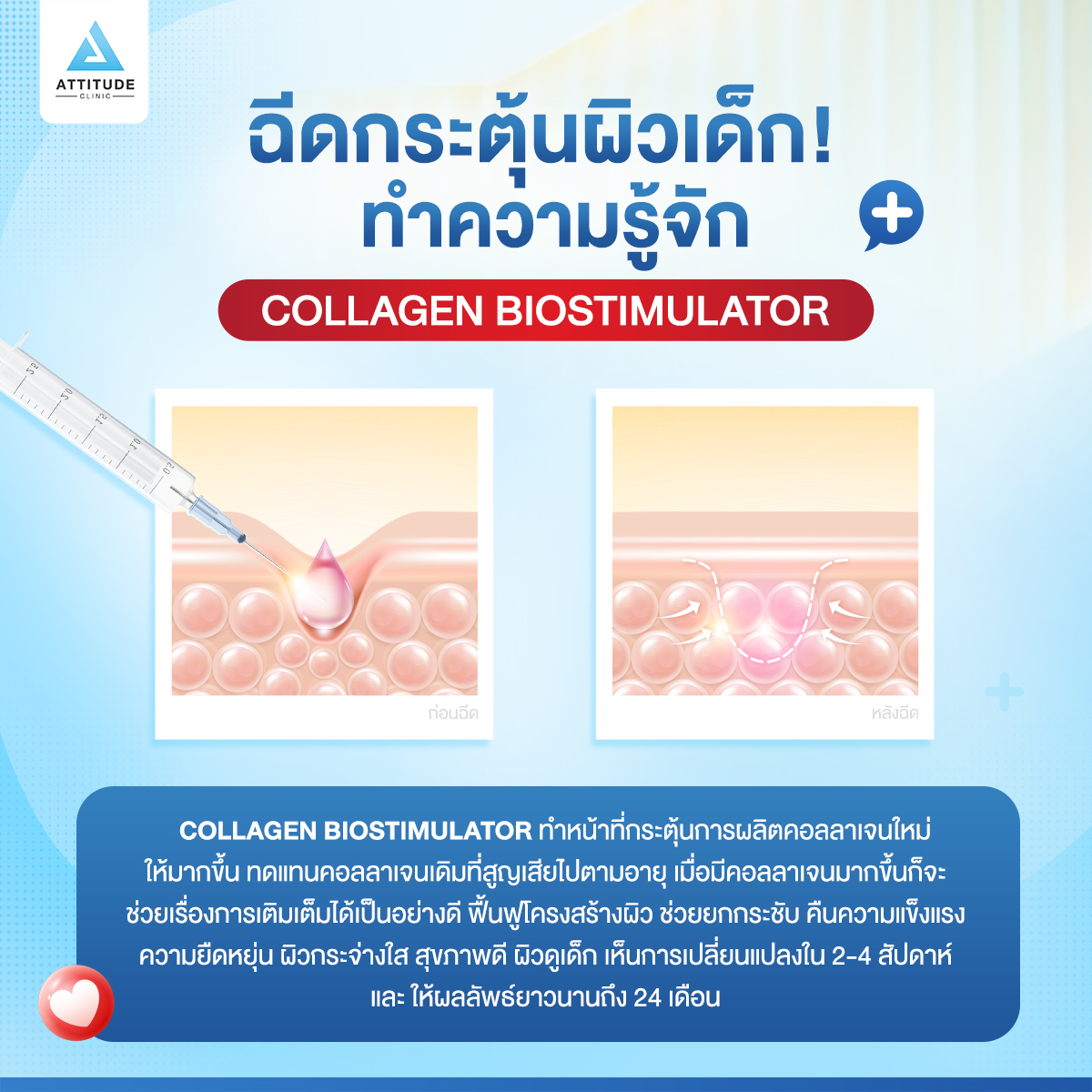 ฉีดกระตุ้นให้ผิวเด็ก ทำความรู้จัก Collagen Biostimulator