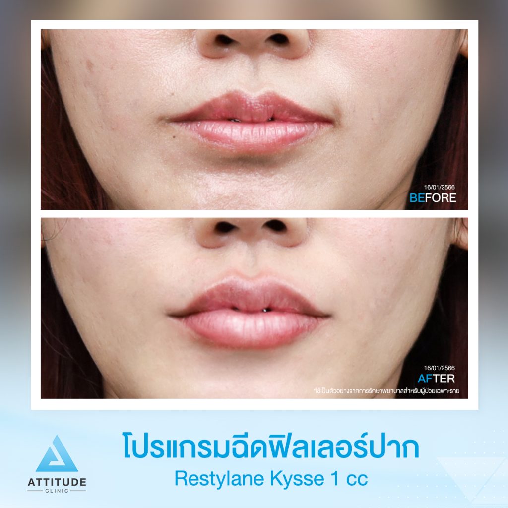 รีวิวฉีดฟิลเลอร์ปากคุณดอกฝ้าย Restylane kysse จำนวน 1 cc ปรับปากบาง เติมเต็มปากให้อวบอิ่ม ดูสุขภาพดี หันมุมไหนก็มั่นใจ ด้วยฟิลเลอร์ที่ออกแบบมาเพื่อฉีดปากโดยเฉพาะที่ 𝗔𝘁𝘁𝗶𝘁𝘂𝗱𝗲 𝗖𝗹𝗶𝗻𝗶𝗰 ✨