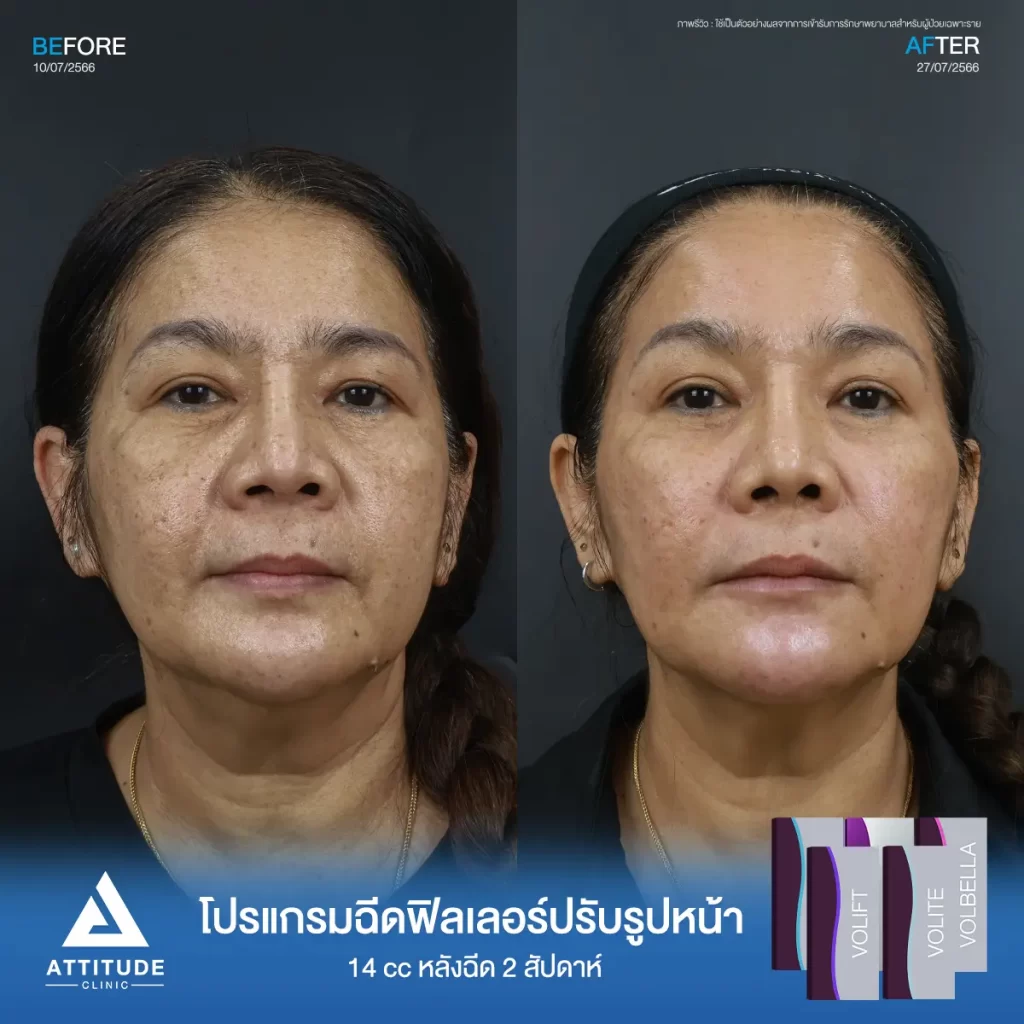 รีวิวโปรแกรมฉีดฟิลเลอร์ทั่วใบหน้า จำนวน 14 cc เติมเต็มริ้วรอย ร่องลึก ปรับรูปหน้าให้ดูอ่อนเยาว์ลง กลับมาสดใสอีกครั้ง ดูแลโดยแพทย์มากประสบการณ์ที่ Attitude Clinic