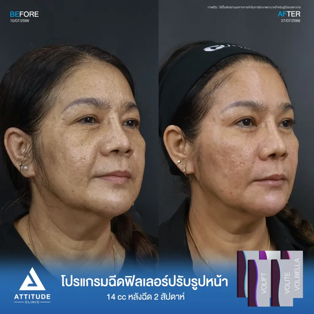 รีวิวโปรแกรมฉีดฟิลเลอร์ทั่วใบหน้า จำนวน 14 cc เติมเต็มริ้วรอย ร่องลึก ปรับรูปหน้าให้ดูอ่อนเยาว์ลง กลับมาสดใสอีกครั้ง ดูแลโดยแพทย์มากประสบการณ์ที่ Attitude Clinic