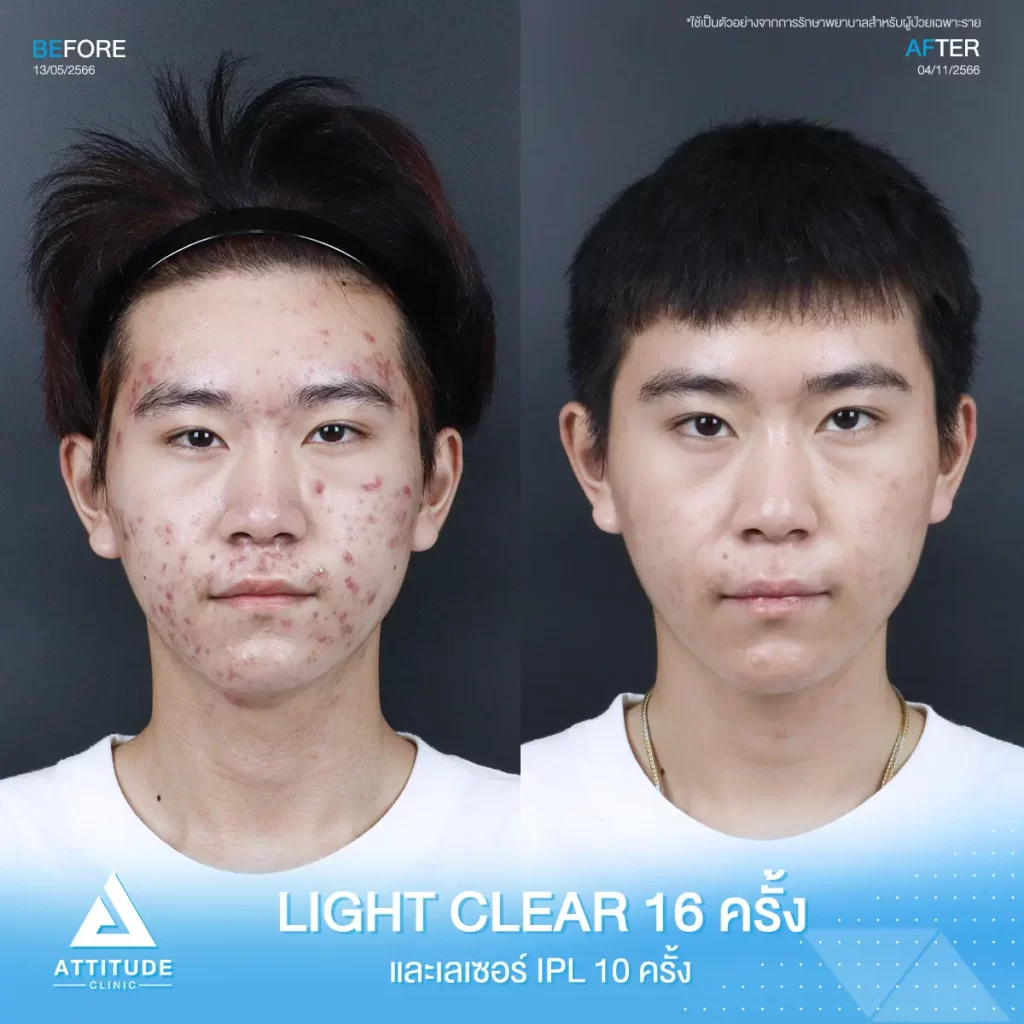 รีวิวรักษาสิวน้องพีพี ด้วยการฉายแสง Light Clear 7 ขั้นตอน จำนวน 10 ครั้ง เลเซอร์หน้าใส Cellec V IPL จำนวน 10 ครั้ง ที่มีปัญหาสิวอักเสบ อุดตัน รอยแดงสิว หลังรักษาสิวหาย มั่นใจมากขึ้นจริง