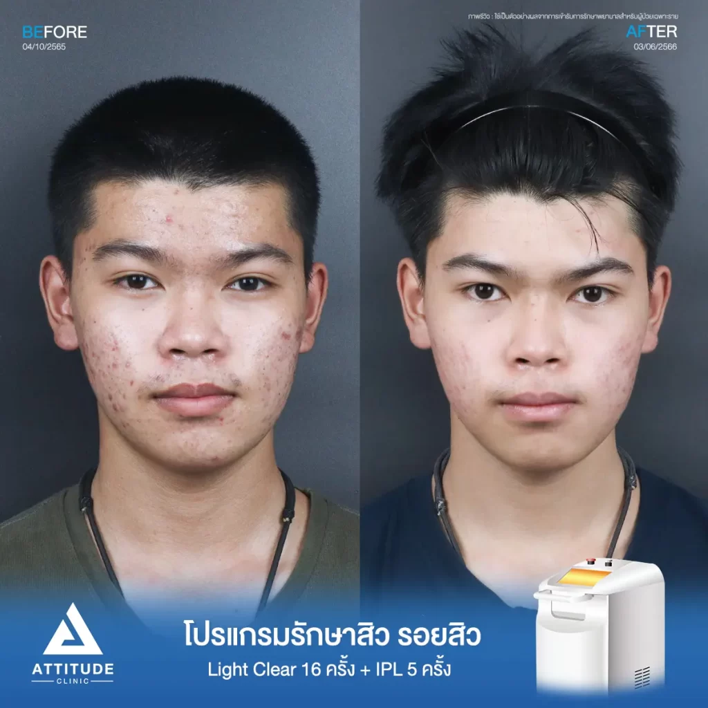 รีวิวรักษาสิวคุณท็อป ด้วยการฉายแสง Light Clear 7 ขั้นตอน จำนวน 16 ครั้ง และทำ IPL หน้าใส ลดรอยสิว จำนวน 5 ครั้ง รักษาสิวอักเสบ สิวอุดตัน และรอยแดงจากสิวทั่วใบหน้าที่ Attitude Clinic