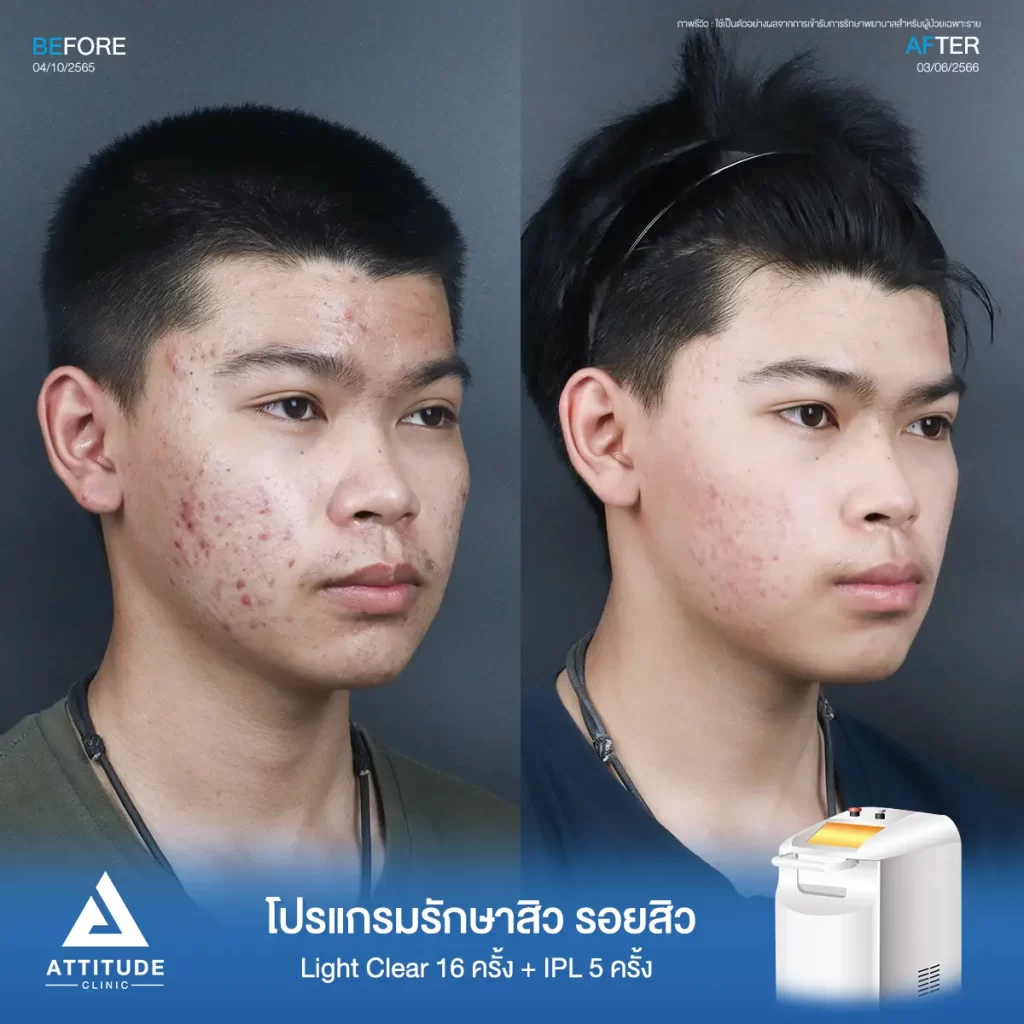 รีวิวรักษาสิวคุณท็อป ด้วยการฉายแสง Light Clear 7 ขั้นตอน จำนวน 16 ครั้ง และทำ IPL หน้าใส ลดรอยสิว จำนวน 5 ครั้ง รักษาสิวอักเสบ สิวอุดตัน และรอยแดงจากสิวทั่วใบหน้าที่ Attitude Clinic