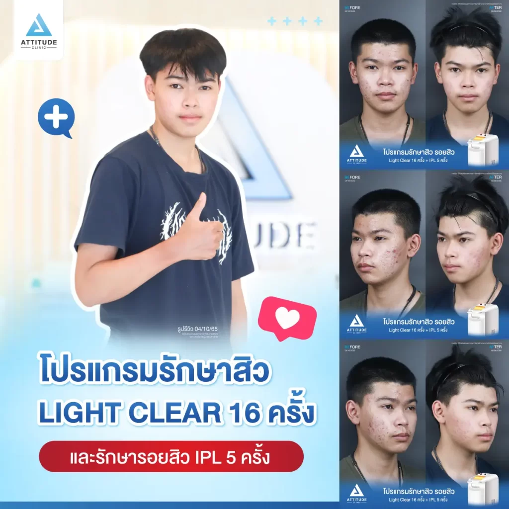 รีวิวรักษาสิวคุณท็อป ด้วยการฉายแสง Light Clear 7 ขั้นตอน จำนวน 16 ครั้ง และทำ IPL หน้าใส ลดรอยสิว จำนวน 5 ครั้ง รักษาสิวอักเสบ สิวอุดตัน และรอยแดงจากสิวทั่วใบหน้าที่ Attitude Clinic