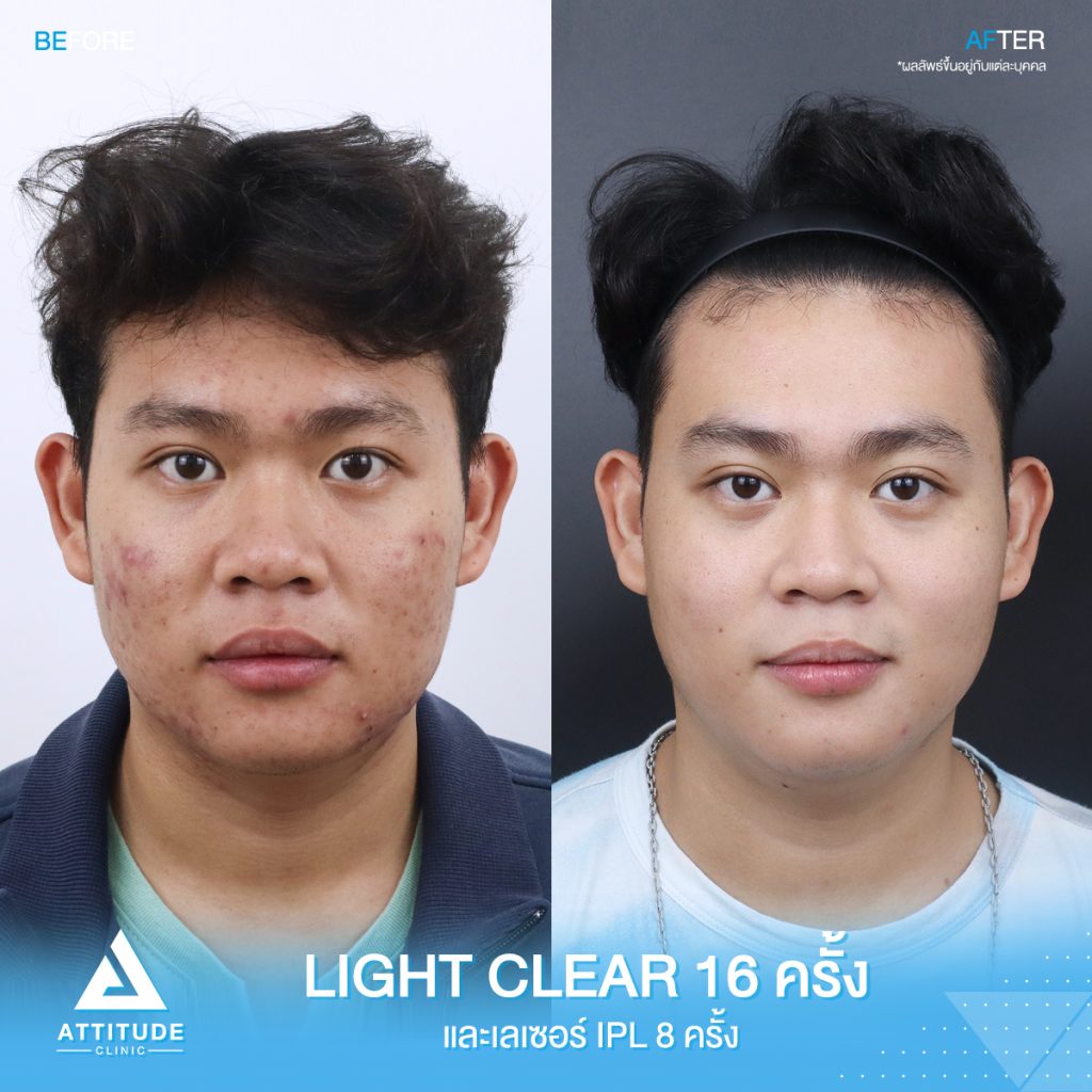 รีวิวรักษาสิวคุณภูมิ ด้วยการฉายแสง Light Clear 7 ขั้นตอน จำนวน 16 ครั้ง และเลเซอร์หน้าใส Cellec V IPL จำนวน 8 ครั้ง ของคุณภูมิ ที่มีปัญหาสิว และรอยสิว อยากให้ผิวหน้าเรียบเนียนขึ้น ผิวใส เพิ่มความมั่นใจ