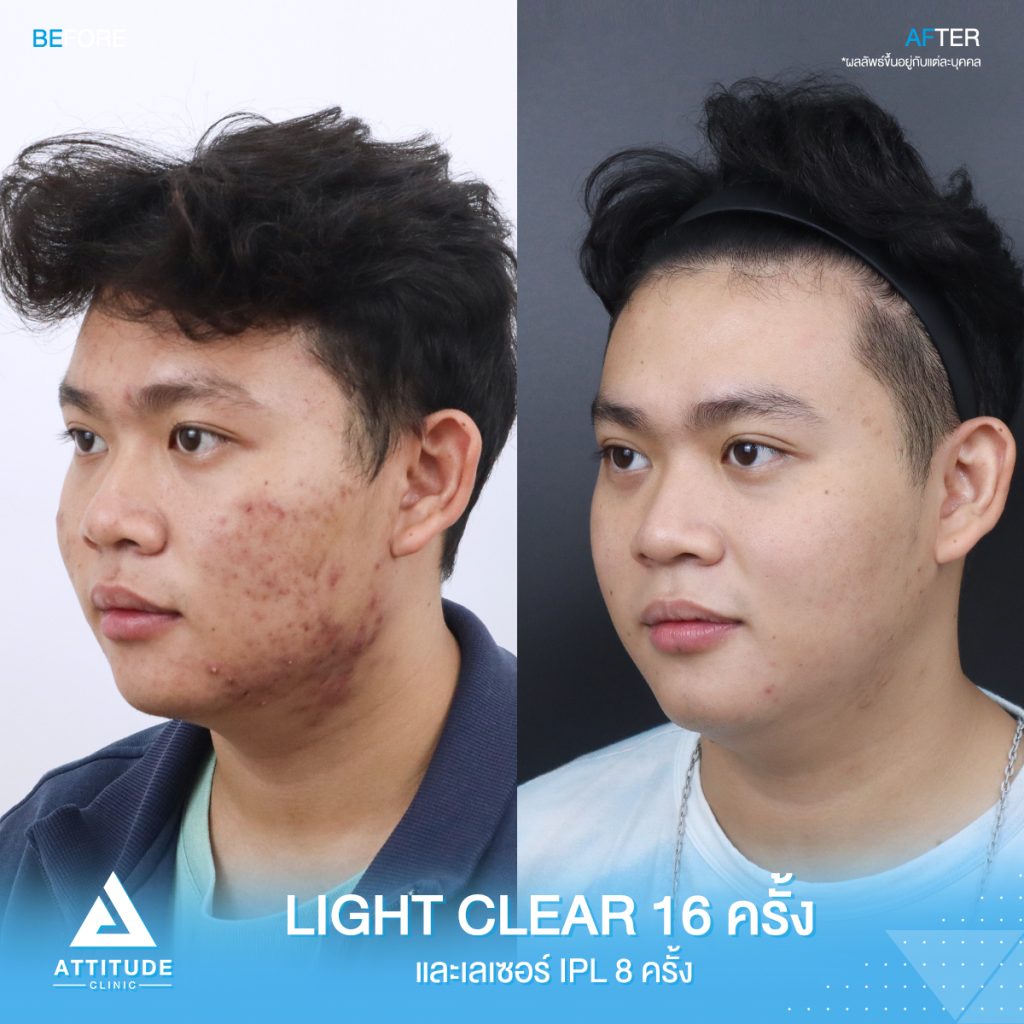 รีวิวรักษาสิวคุณภูมิ ด้วยการฉายแสง Light Clear 7 ขั้นตอน จำนวน 16 ครั้ง และเลเซอร์หน้าใส Cellec V IPL จำนวน 8 ครั้ง ของคุณภูมิ ที่มีปัญหาสิว และรอยสิว อยากให้ผิวหน้าเรียบเนียนขึ้น ผิวใส เพิ่มความมั่นใจ