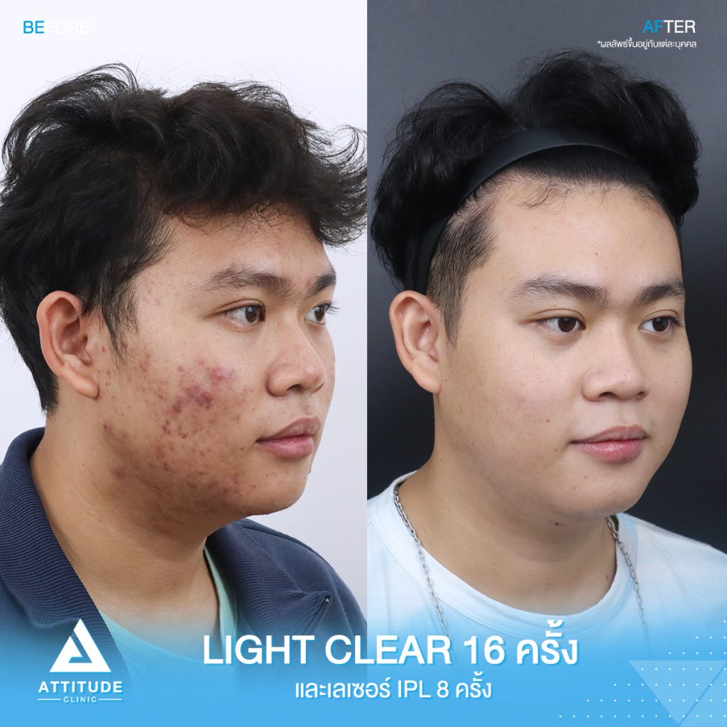 รีวิวรักษาสิวคุณภูมิ ด้วยการฉายแสง Light Clear 7 ขั้นตอน จำนวน 16 ครั้ง และเลเซอร์หน้าใส Cellec V IPL จำนวน 8 ครั้ง ของคุณภูมิ ที่มีปัญหาสิว และรอยสิว อยากให้ผิวหน้าเรียบเนียนขึ้น ผิวใส เพิ่มความมั่นใจ