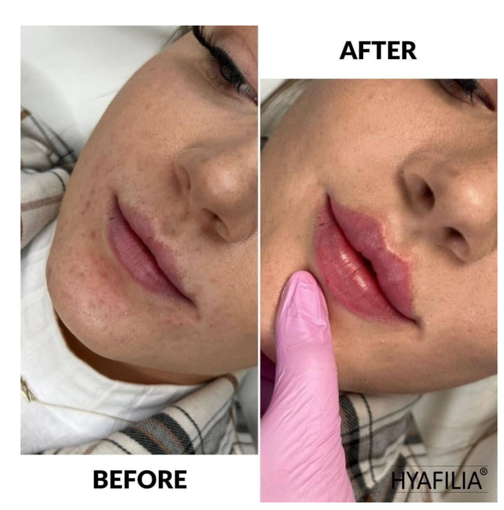 รีวิวฟิลเลอร์ Hyafilia filler