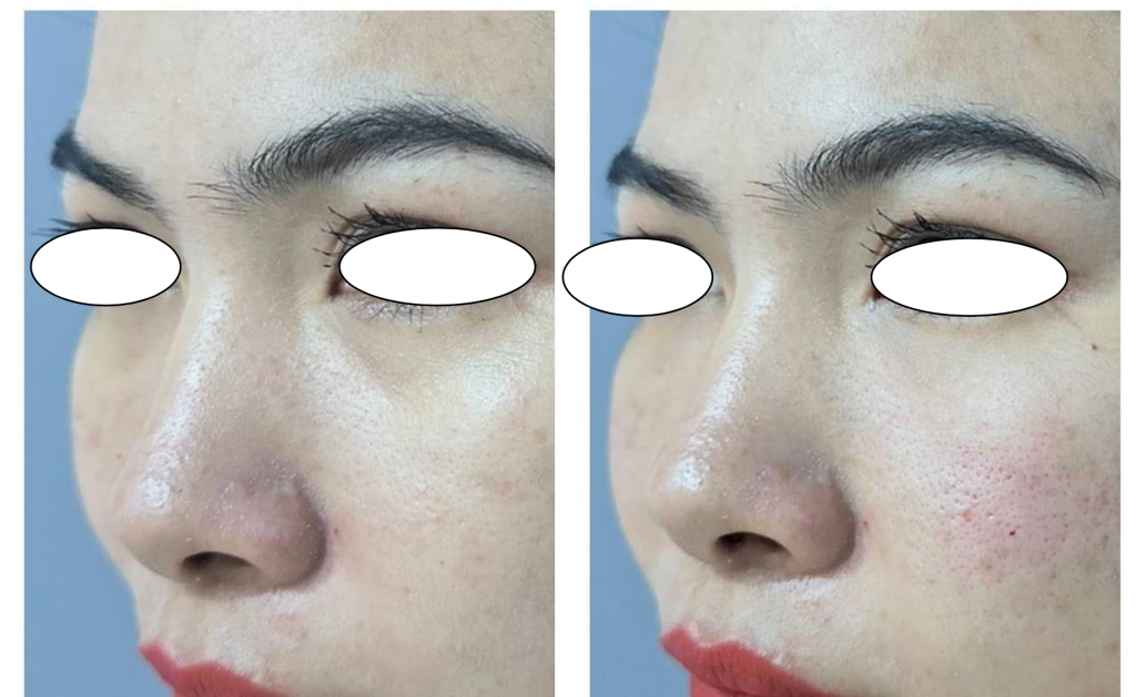 รีวิวฟิลเลอร์ Hyafilia filler