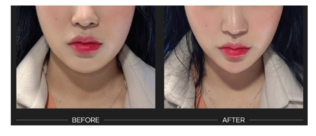 รีวิวฟิลเลอร์ Hyafilia filler