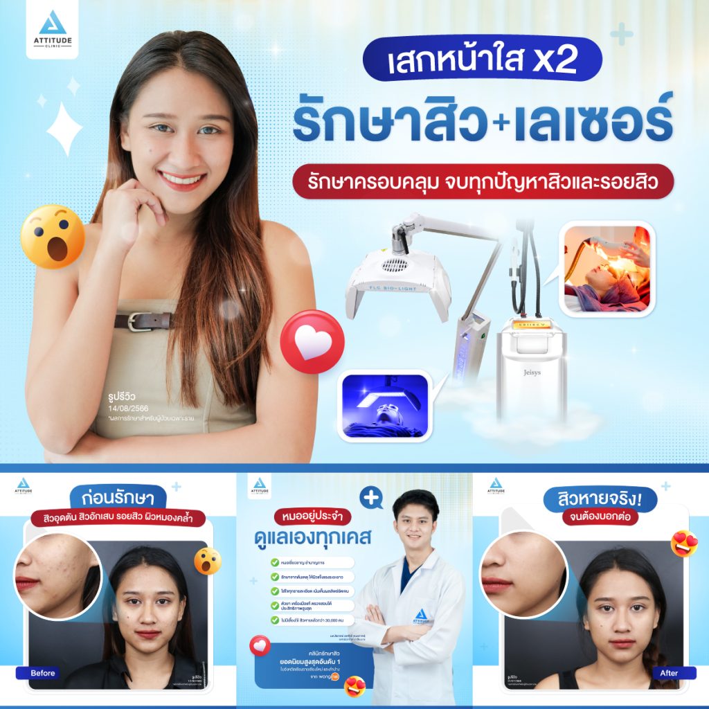 เสกหน้าใส แบบคูณ 2 ต้องรักษาสิว + เลเซอร์ รักษาครอบคลุม จบทุกปัญหาสิวและรอยสิว