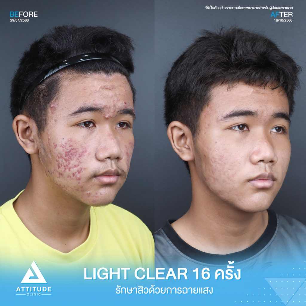 รีวิวรักษาสิวคุณพีรัชชัย ด้วยการฉายแสง Light Clear 7 ขั้นตอน จำนวน 16 ครั้ง ที่มีปัญหาสิวอักเสบ สิวอุดตัน และรอยแดงจากสิวทั่วใบหน้า จนทำให้ไม่มั่นใจ หลังรักษาครบคอร์สหน้าใสขึ้น ผิวดีขึ้นจริง