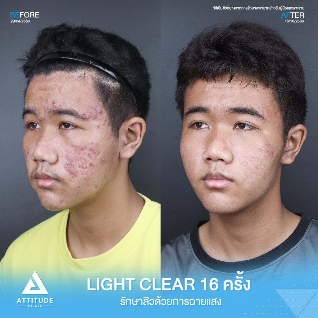 รีวิวรักษาสิวคุณพีรัชชัย ด้วยการฉายแสง Light Clear 7 ขั้นตอน จำนวน 16 ครั้ง ที่มีปัญหาสิวอักเสบ สิวอุดตัน และรอยแดงจากสิวทั่วใบหน้า จนทำให้ไม่มั่นใจ หลังรักษาครบคอร์สหน้าใสขึ้น ผิวดีขึ้นจริง