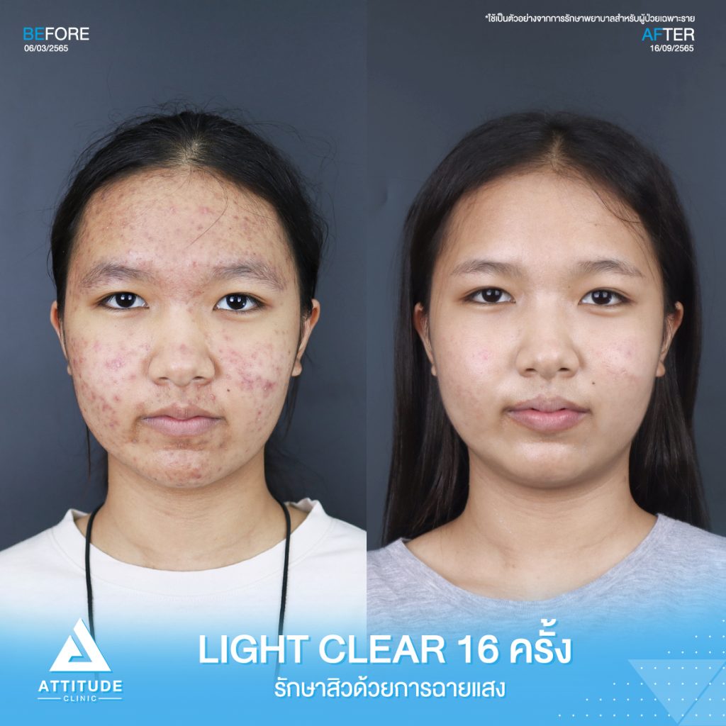 รีวิวรักษาสิวคุณไหมแพรวา ด้วยการฉายแสง Light Clear 7 ขั้นตอน จำนวน 16 ครั้ง ที่มีปัญหาสิวเห่อทั่วใบหน้า จนทำให้ไม่มั่นใจ หลังรักษาครบคอร์สหน้าใสขึ้น ผิวดีขึ้นจริง