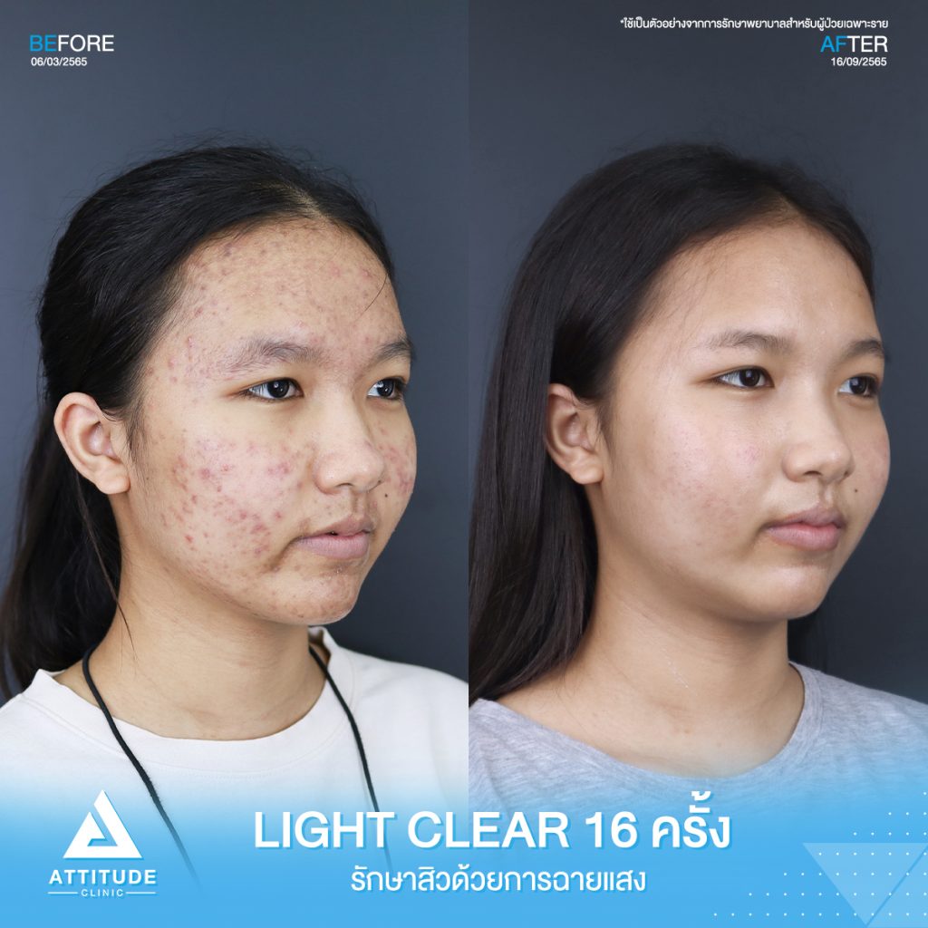 รีวิวรักษาสิวคุณไหมแพรวา ด้วยการฉายแสง Light Clear 7 ขั้นตอน จำนวน 16 ครั้ง ที่มีปัญหาสิวเห่อทั่วใบหน้า จนทำให้ไม่มั่นใจ หลังรักษาครบคอร์สหน้าใสขึ้น ผิวดีขึ้นจริง