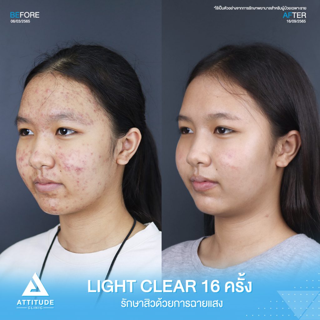 รีวิวรักษาสิวคุณไหมแพรวา ด้วยการฉายแสง Light Clear 7 ขั้นตอน จำนวน 16 ครั้ง ที่มีปัญหาสิวเห่อทั่วใบหน้า จนทำให้ไม่มั่นใจ หลังรักษาครบคอร์สหน้าใสขึ้น ผิวดีขึ้นจริง