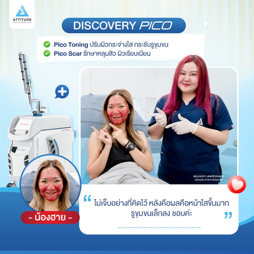 รีวิวทำ Discovery Pico จากลูกค้า เลเซอร์เลือดสาด ตัวดังจากอิตาลี รักษาครบทุกปัญหาผิว