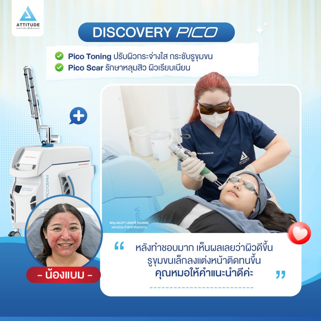 รีวิวทำ Discovery Pico จากลูกค้า เลเซอร์เลือดสาด ตัวดังจากอิตาลี รักษาครบทุกปัญหาผิว