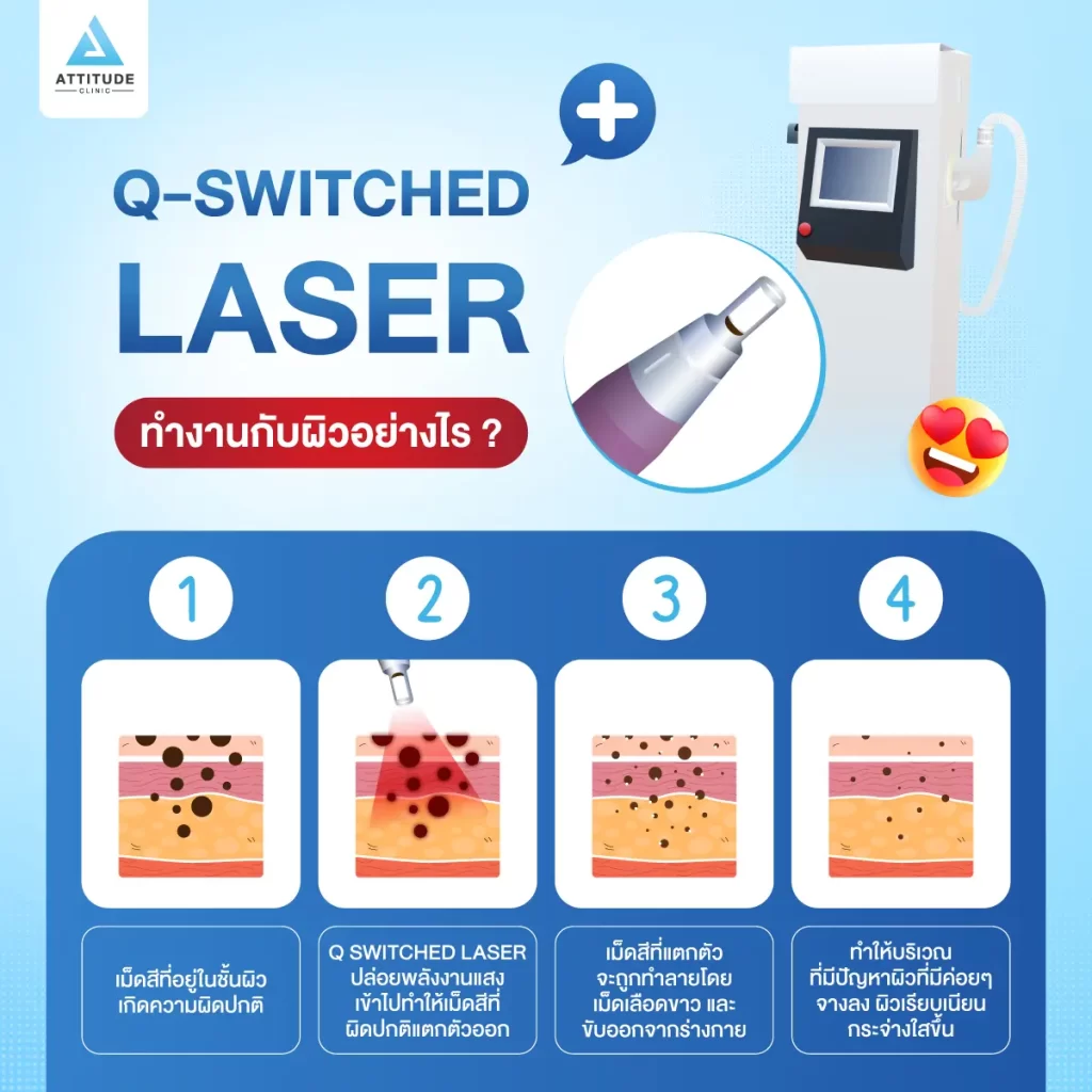 ข้อมูลครบ! Q Switched Laser พารู้จักเลเซอร์หน้าใส รักษาฝ้า กระ จุดด่างดำ ฟื้นฟูผิวให้กระจ่างใส เรียบเนียน ไร้รอยกวนใจ Yag Q Switched Laser คืออะไร? Q Switched Laser รีวิว? Q Switched Laser กี่ครั้งเห็นผล? Q Switched Laser 1 ครั้ง ราคา?