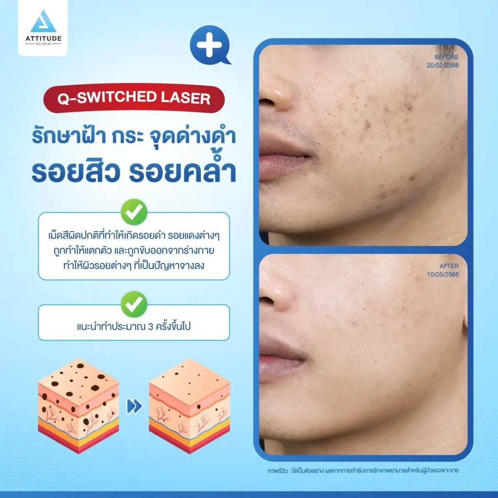 ข้อมูลครบ! Q Switched Laser พารู้จักเลเซอร์หน้าใส รักษาฝ้า กระ จุดด่างดำ ฟื้นฟูผิวให้กระจ่างใส เรียบเนียน ไร้รอยกวนใจ Yag Q Switched Laser คืออะไร? Q Switched Laser รีวิว? Q Switched Laser กี่ครั้งเห็นผล? Q Switched Laser 1 ครั้ง ราคา?