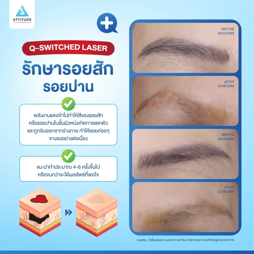 ข้อมูลครบ! Q Switched Laser พารู้จักเลเซอร์หน้าใส รักษาฝ้า กระ จุดด่างดำ ฟื้นฟูผิวให้กระจ่างใส เรียบเนียน ไร้รอยกวนใจ Yag Q Switched Laser คืออะไร? Q Switched Laser รีวิว? Q Switched Laser กี่ครั้งเห็นผล? Q Switched Laser 1 ครั้ง ราคา?