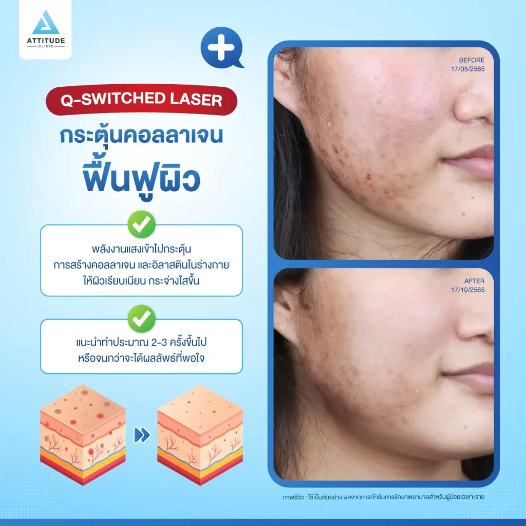 ข้อมูลครบ! Q Switched Laser พารู้จักเลเซอร์หน้าใส รักษาฝ้า กระ จุดด่างดำ ฟื้นฟูผิวให้กระจ่างใส เรียบเนียน ไร้รอยกวนใจ Yag Q Switched Laser คืออะไร? Q Switched Laser รีวิว? Q Switched Laser กี่ครั้งเห็นผล? Q Switched Laser 1 ครั้ง ราคา?