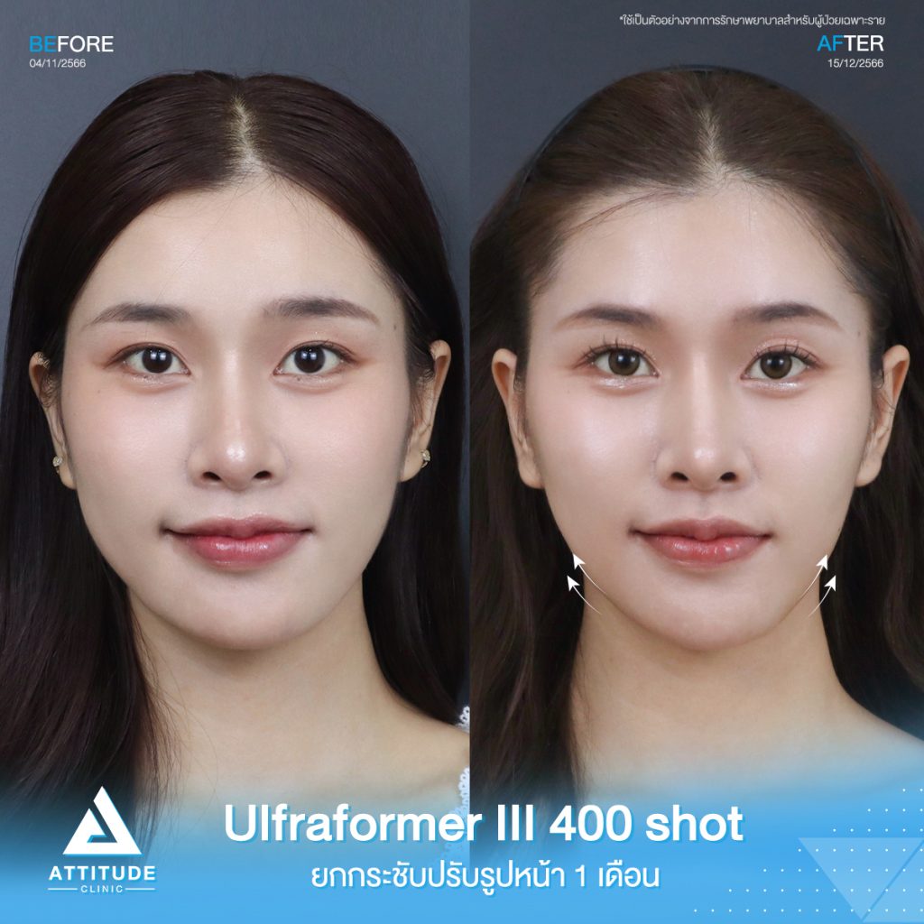 Ultraformer III อยากยกหน้าตึง ต้องใช้กี่ช็อต?