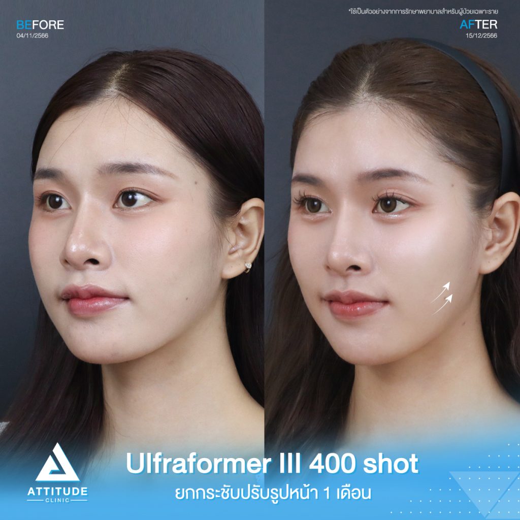 Ultraformer III อยากยกหน้าตึง ต้องใช้กี่ช็อต?