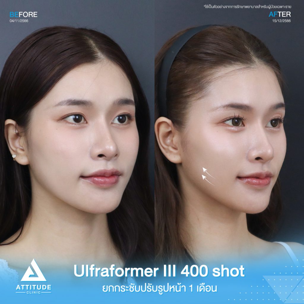 Ultraformer III อยากยกหน้าตึง ต้องใช้กี่ช็อต?