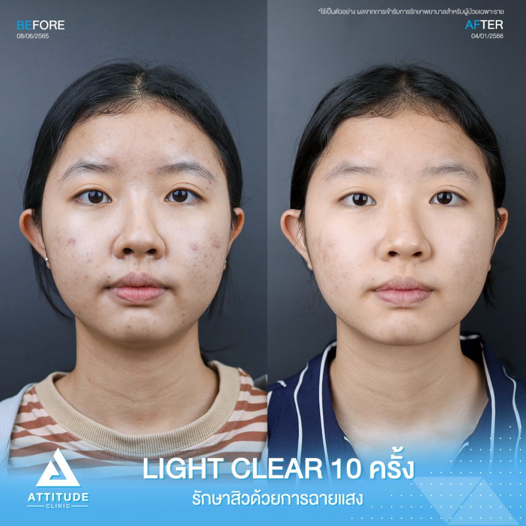 รีวิวรักษาสิวคุณจิณห์นิภา ด้วยการฉายแสง Light Clear 7 ขั้นตอน จำนวน 10 ครั้ง ที่มีปัญหาสิวอักเสบ สิวอุดตัน และรอยแดงจากสิวโดยเฉพาะบริเวณแก้ม 2 ข้าง ทำให้ไม่มั่นใจ อยากให้ผิวกลับมาเนียนใสไร้สิวอีกครั้ง