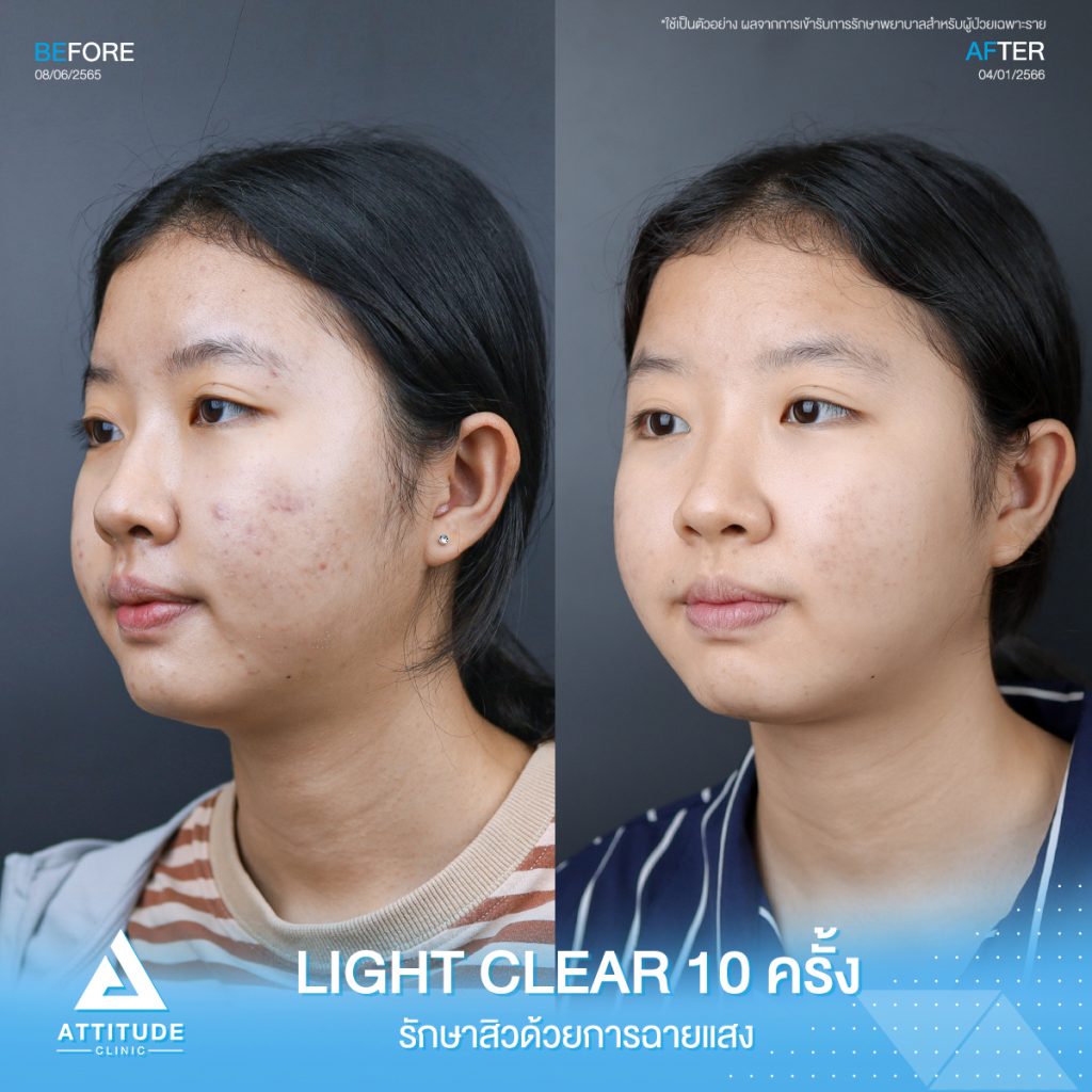 รีวิวรักษาสิวคุณจิณห์นิภา ด้วยการฉายแสง Light Clear 7 ขั้นตอน จำนวน 10 ครั้ง ที่มีปัญหาสิวอักเสบ สิวอุดตัน และรอยแดงจากสิวโดยเฉพาะบริเวณแก้ม 2 ข้าง ทำให้ไม่มั่นใจ อยากให้ผิวกลับมาเนียนใสไร้สิวอีกครั้ง