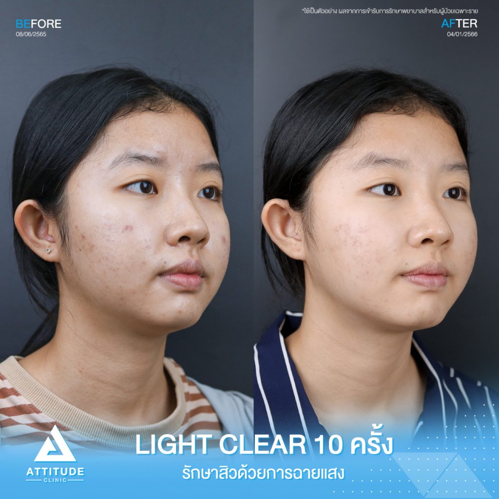 รีวิวรักษาสิวคุณจิณห์นิภา ด้วยการฉายแสง Light Clear 7 ขั้นตอน จำนวน 10 ครั้ง ที่มีปัญหาสิวอักเสบ สิวอุดตัน และรอยแดงจากสิวโดยเฉพาะบริเวณแก้ม 2 ข้าง ทำให้ไม่มั่นใจ อยากให้ผิวกลับมาเนียนใสไร้สิวอีกครั้ง