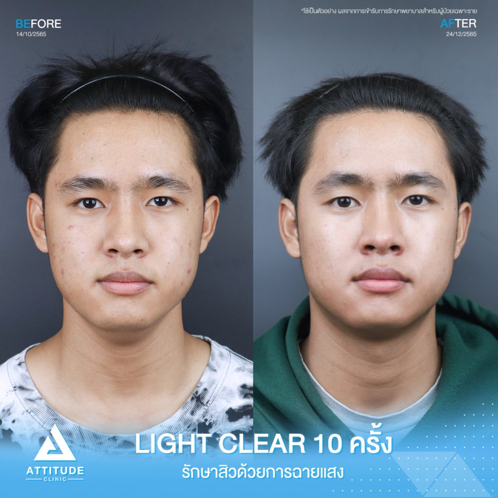 รีวิวรักษาสิวคุณพณิชพล ด้วยการฉายแสง Light Clear 7 ขั้นตอน จำนวน 10 ครั้ง ที่มีปัญหาสิวอักเสบ สิวอุดตัน และรอยแดงจากสิว อยากให้ผิวกลับมาเนียนใสไร้สิวอีกครั้ง