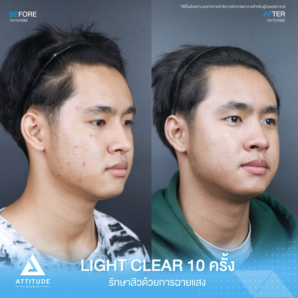 รีวิวรักษาสิวคุณพณิชพล ด้วยการฉายแสง Light Clear 7 ขั้นตอน จำนวน 10 ครั้ง ที่มีปัญหาสิวอักเสบ สิวอุดตัน และรอยแดงจากสิว อยากให้ผิวกลับมาเนียนใสไร้สิวอีกครั้ง