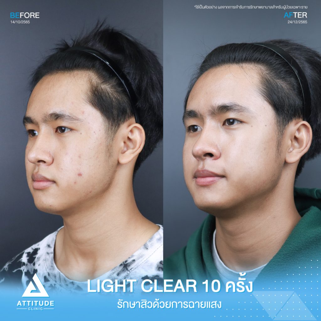 รีวิวรักษาสิวคุณพณิชพล ด้วยการฉายแสง Light Clear 7 ขั้นตอน จำนวน 10 ครั้ง ที่มีปัญหาสิวอักเสบ สิวอุดตัน และรอยแดงจากสิว อยากให้ผิวกลับมาเนียนใสไร้สิวอีกครั้ง