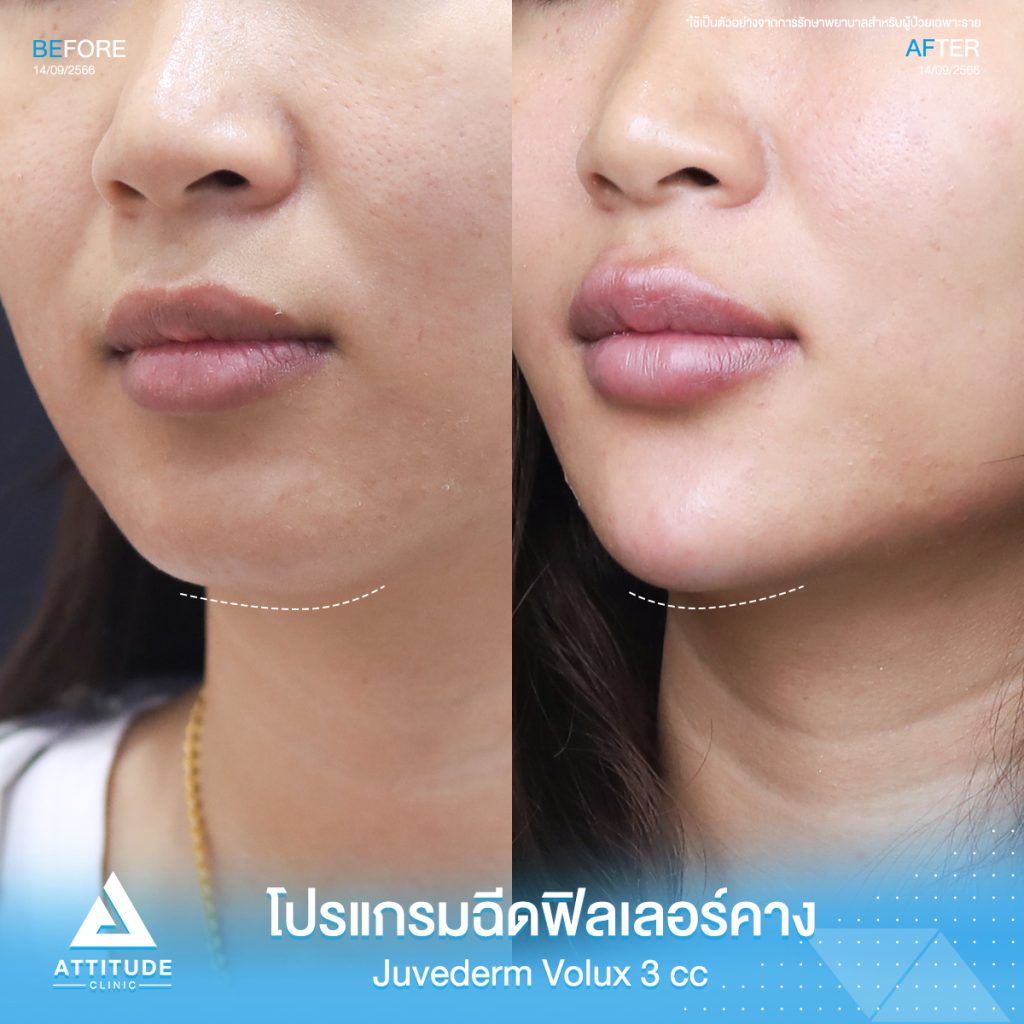 รีวิวโปรแกรมฉีดฟิลเลอร์คางคุณพัชรินทร์ Juvederm Volux จำนวน 3 cc ปรับรูปคางให้ดูเรียว เพิ่มมิติให้ได้สัดส่วน หน้าเป๊ะ หันมุมไหนก็มั่นใจที่ 𝗔𝘁𝘁𝗶𝘁𝘂𝗱𝗲 𝗖𝗹𝗶𝗻𝗶𝗰