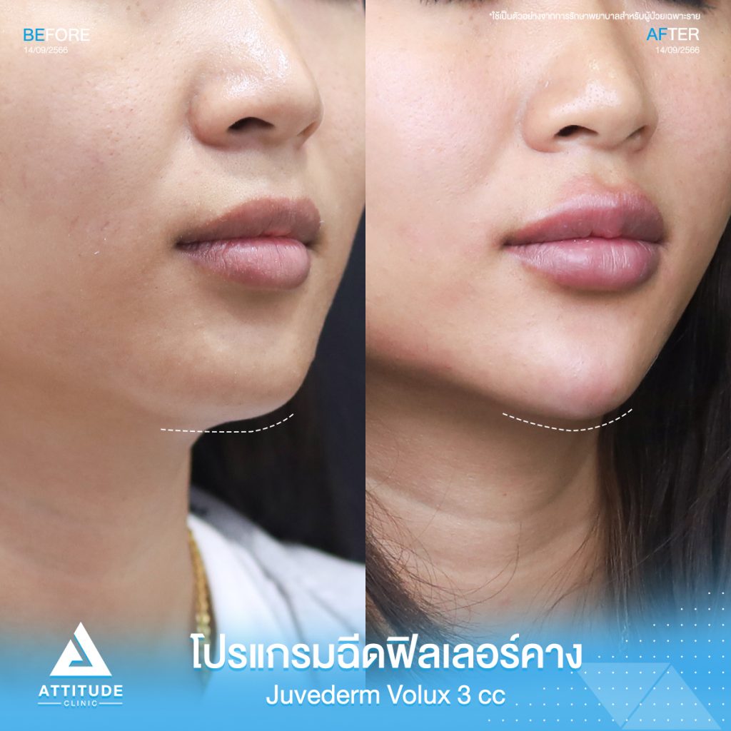 รีวิวโปรแกรมฉีดฟิลเลอร์คางคุณพัชรินทร์ Juvederm Volux จำนวน 3 cc ปรับรูปคางให้ดูเรียว เพิ่มมิติให้ได้สัดส่วน หน้าเป๊ะ หันมุมไหนก็มั่นใจที่ 𝗔𝘁𝘁𝗶𝘁𝘂𝗱𝗲 𝗖𝗹𝗶𝗻𝗶𝗰