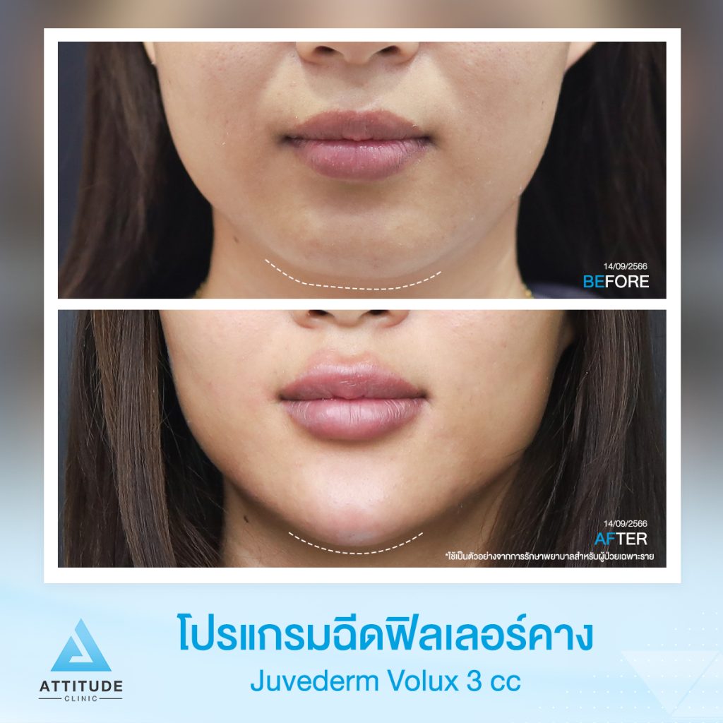 รีวิวโปรแกรมฉีดฟิลเลอร์คางคุณพัชรินทร์ Juvederm Volux จำนวน 3 cc ปรับรูปคางให้ดูเรียว เพิ่มมิติให้ได้สัดส่วน หน้าเป๊ะ หันมุมไหนก็มั่นใจที่ 𝗔𝘁𝘁𝗶𝘁𝘂𝗱𝗲 𝗖𝗹𝗶𝗻𝗶𝗰