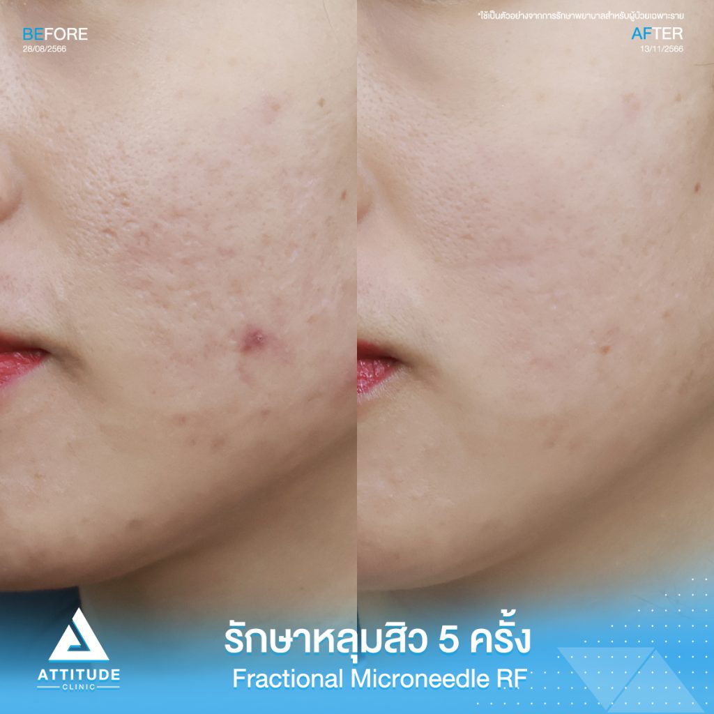 รีวิวรักษาหลุมสิวคุณบีม FRF Scar - Fractional Micro Needle RF จำนวน 5 ครั้ง มีปัญหาหลุมสิว รูขุมขนกว้าว ผิวไม่เรียบเนียน หลังรักษาผิวหน้าดีขึ้น รูขุมขนกระชับ หลุมสิวตื้นขึ้น จนเพื่อนๆทัก เห็นผลจริง มั่นใจสุดๆ