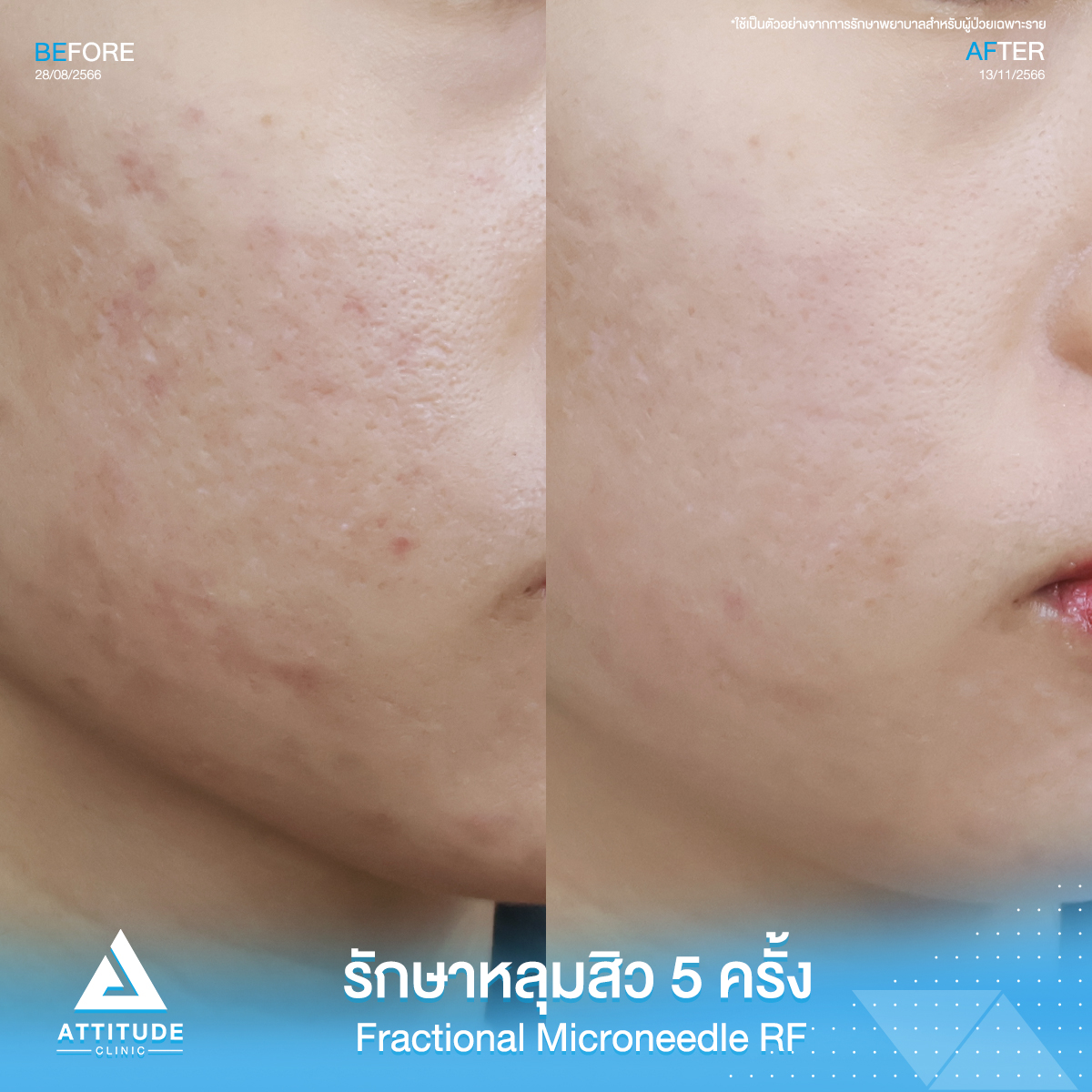 รีวิวรักษาหลุมสิวคุณบีม FRF Scar - Fractional Micro Needle RF จำนวน 5 ครั้ง มีปัญหาหลุมสิว รูขุมขนกว้าว ผิวไม่เรียบเนียน หลังรักษาผิวหน้าดีขึ้น รูขุมขนกระชับ หลุมสิวตื้นขึ้น จนเพื่อนๆทัก เห็นผลจริง มั่นใจสุดๆ