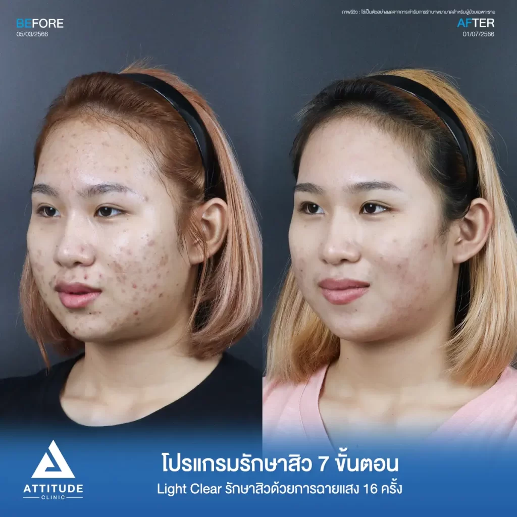 รีวิวรักษาสิวคุณหมวย ด้วยการฉายแสง Light Clear 7 ขั้นตอน จำนวน 16 ครั้ง รักษาสิวอักเสบ สิวอุดตัน และรอยสิวทั่วใบหน้าที่ 𝗔𝘁𝘁𝗶𝘁𝘂𝗱𝗲 𝗖𝗹𝗶𝗻𝗶𝗰