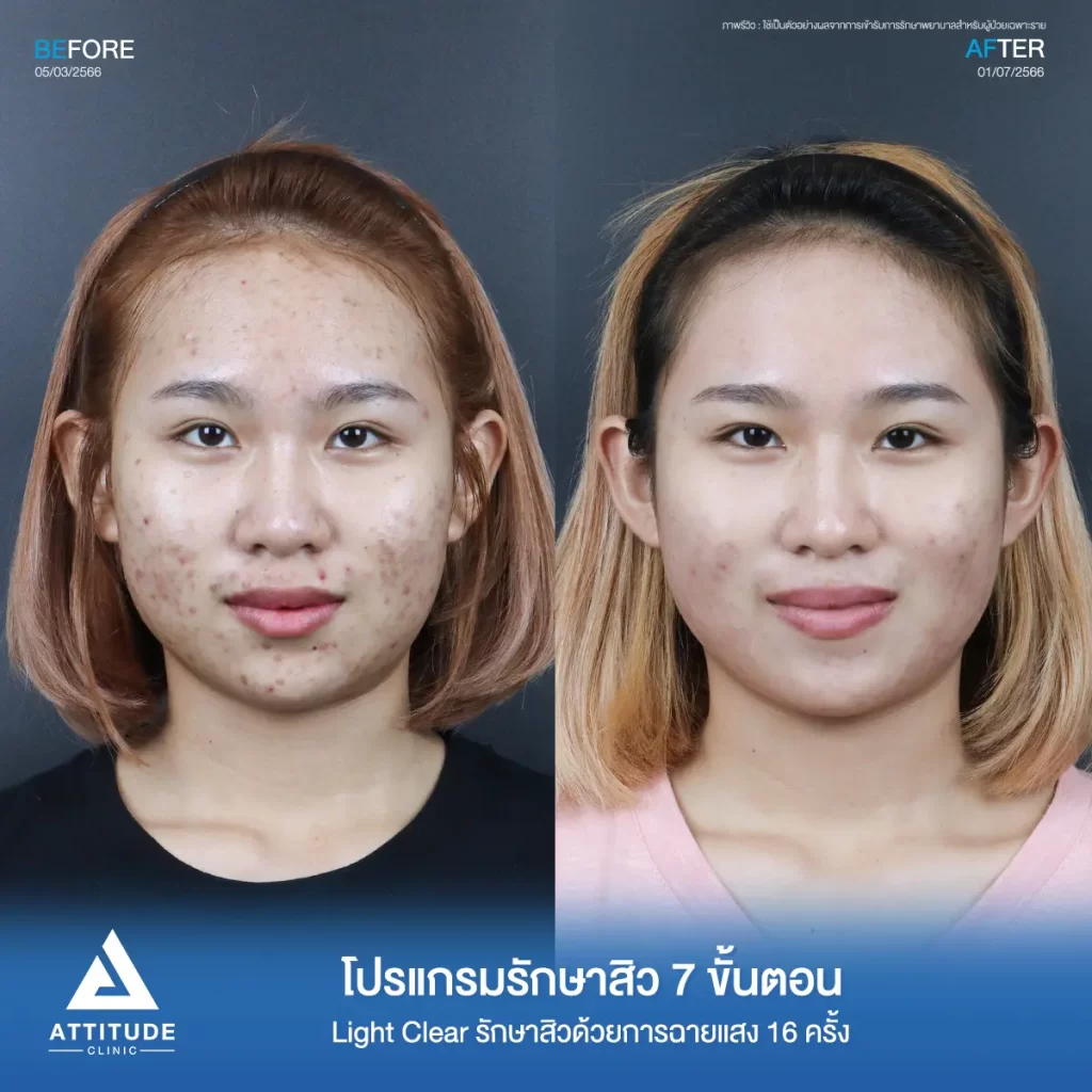 รีวิวรักษาสิวคุณหมวย ด้วยการฉายแสง Light Clear 7 ขั้นตอน จำนวน 16 ครั้ง รักษาสิวอักเสบ สิวอุดตัน และรอยสิวทั่วใบหน้าที่ 𝗔𝘁𝘁𝗶𝘁𝘂𝗱𝗲 𝗖𝗹𝗶𝗻𝗶𝗰